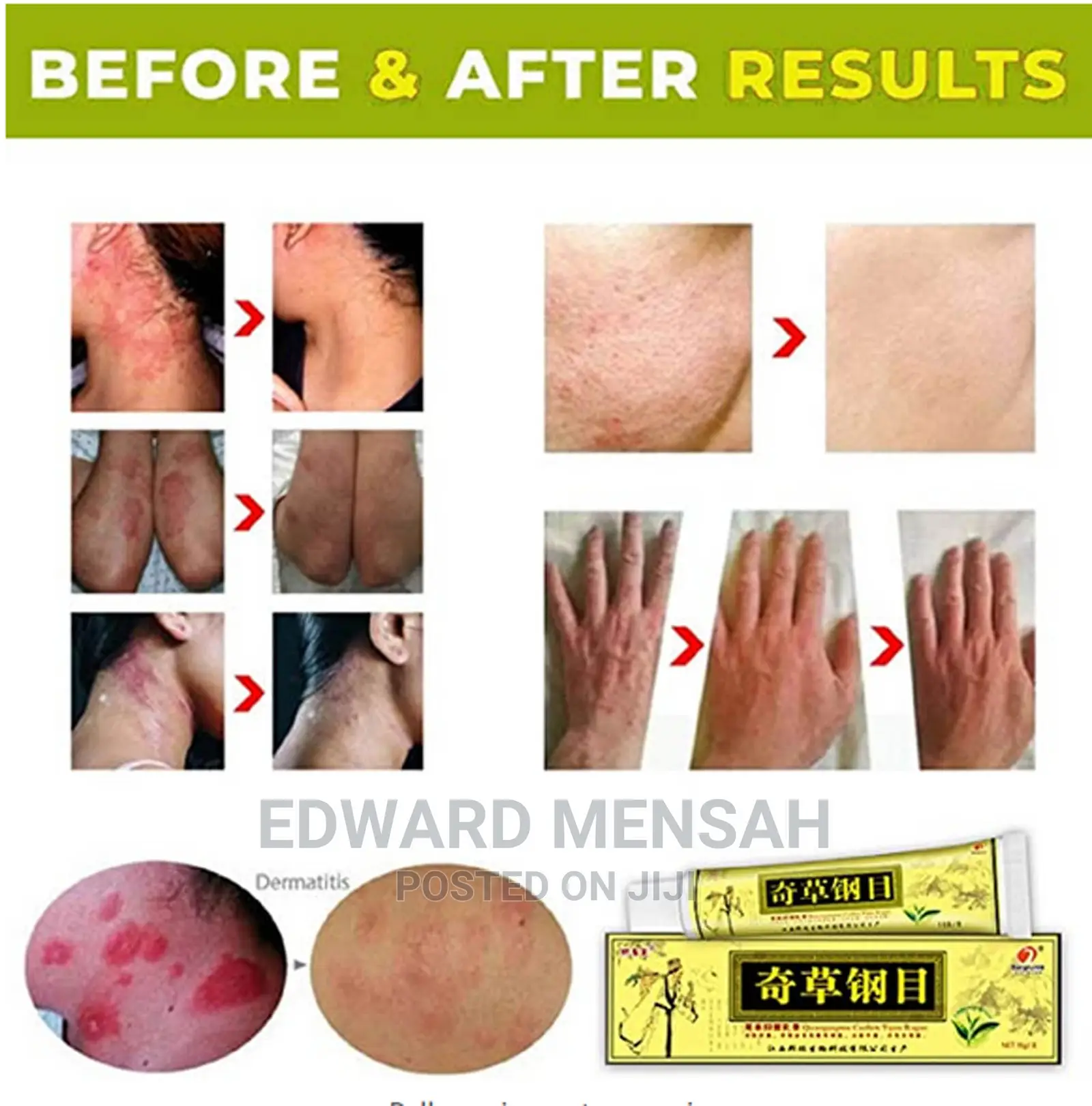 Eczema, Psoriasis