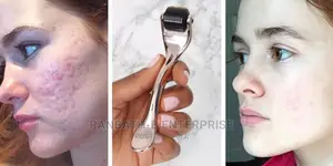 Derma Roller