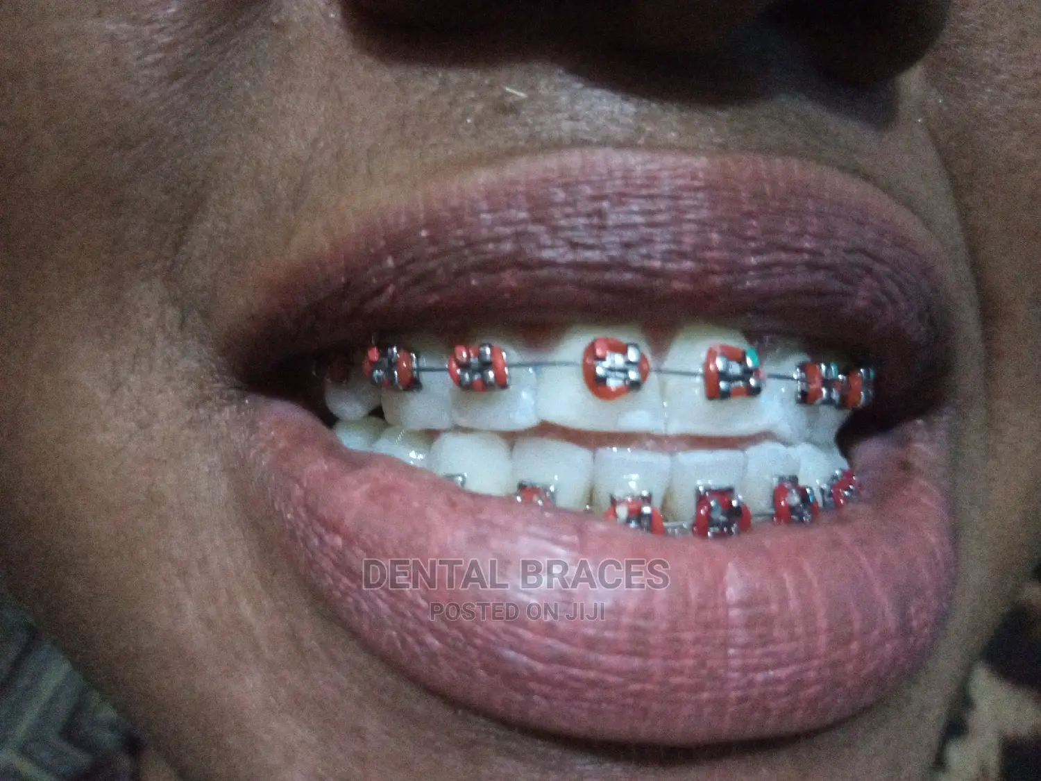 Get Fashion Brace Smile Good