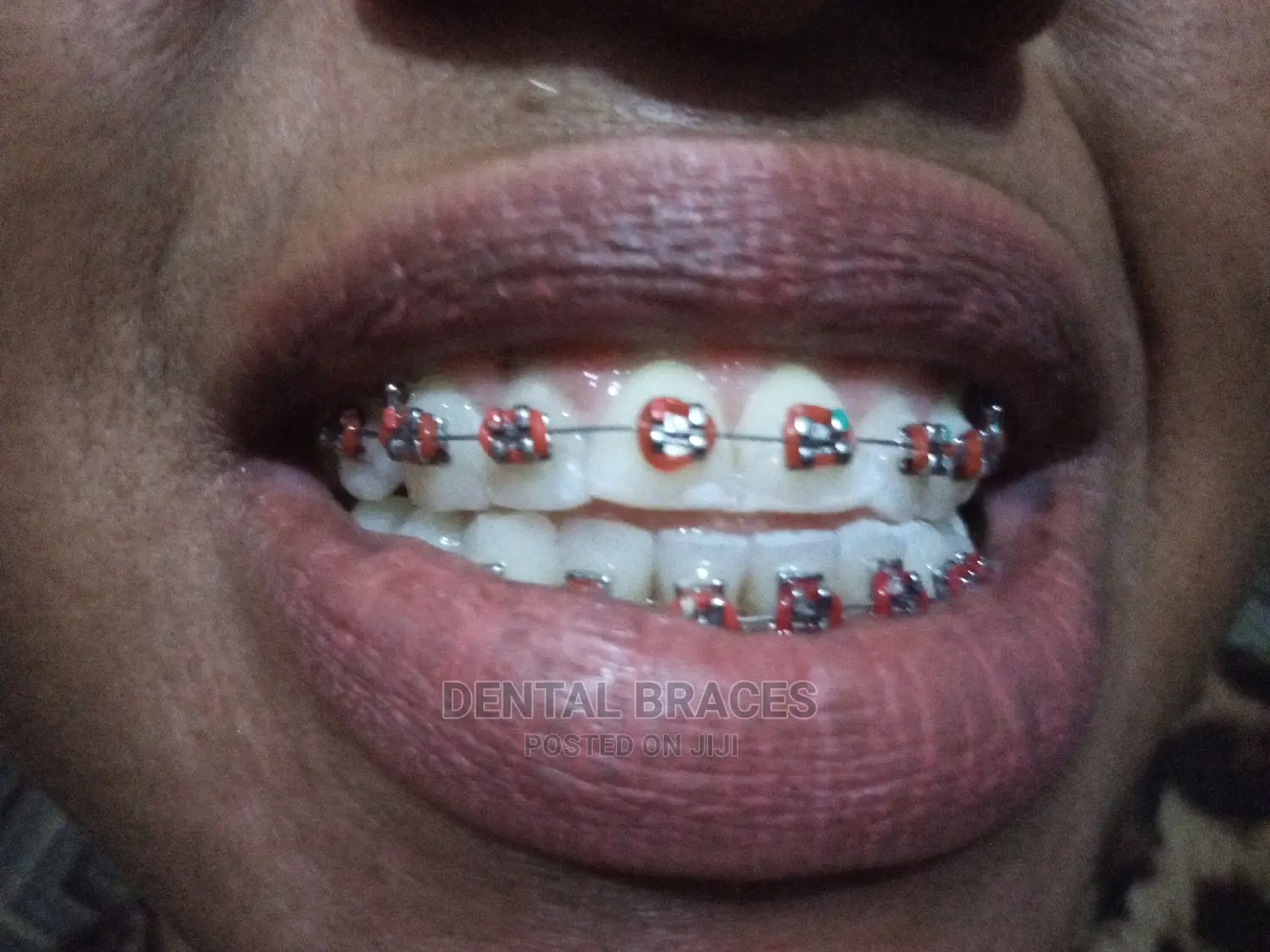 Get Fashion Brace Smile Good