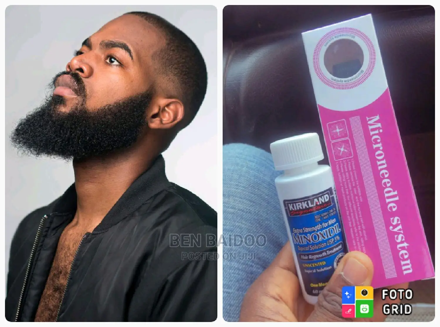 Kirkland Minoxidil and Derma Roller (Best Beard Plug)