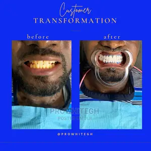 Instant Teethwhitening Service