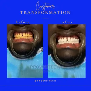 Effective Instant Teethwitening Service
