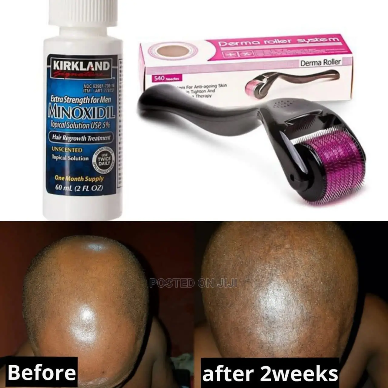 Kirkland Minoxidil and Derma Roller Combo for Hair Growth