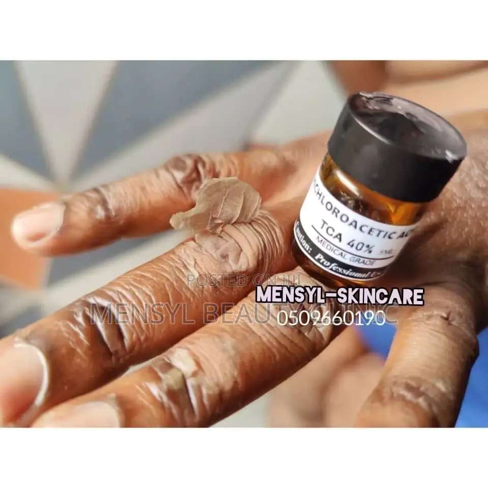 Tca Chemical Peel Solution