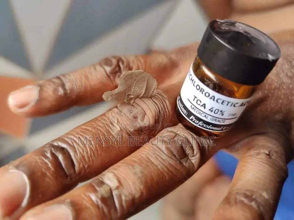 Tca Chemical Peel Solution