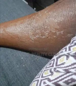Tca Chemical Peel Solution