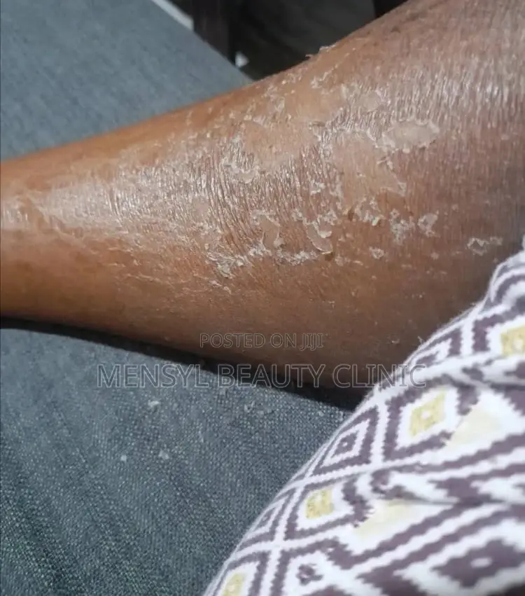 Tca Chemical Peel Solution
