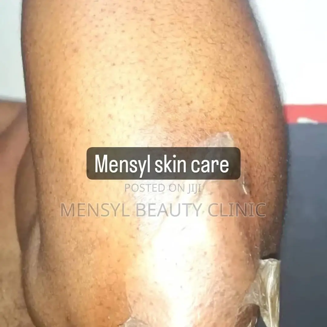 Tca Chemical Peel Solution