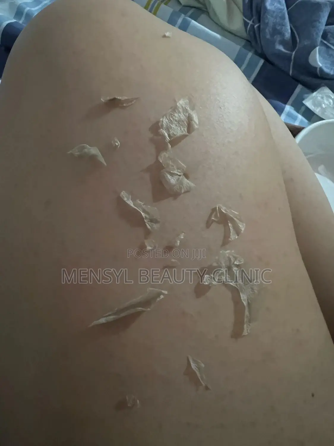 Tca Chemical Peel Solution