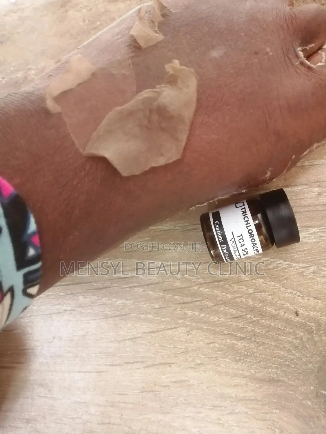 Tca Chemical Peel Solution