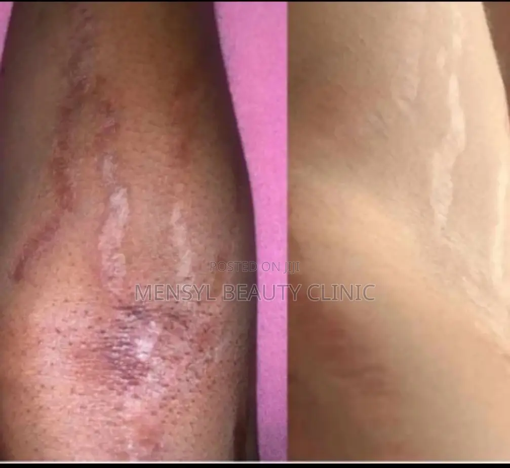 Tca Chemical Peel Solution