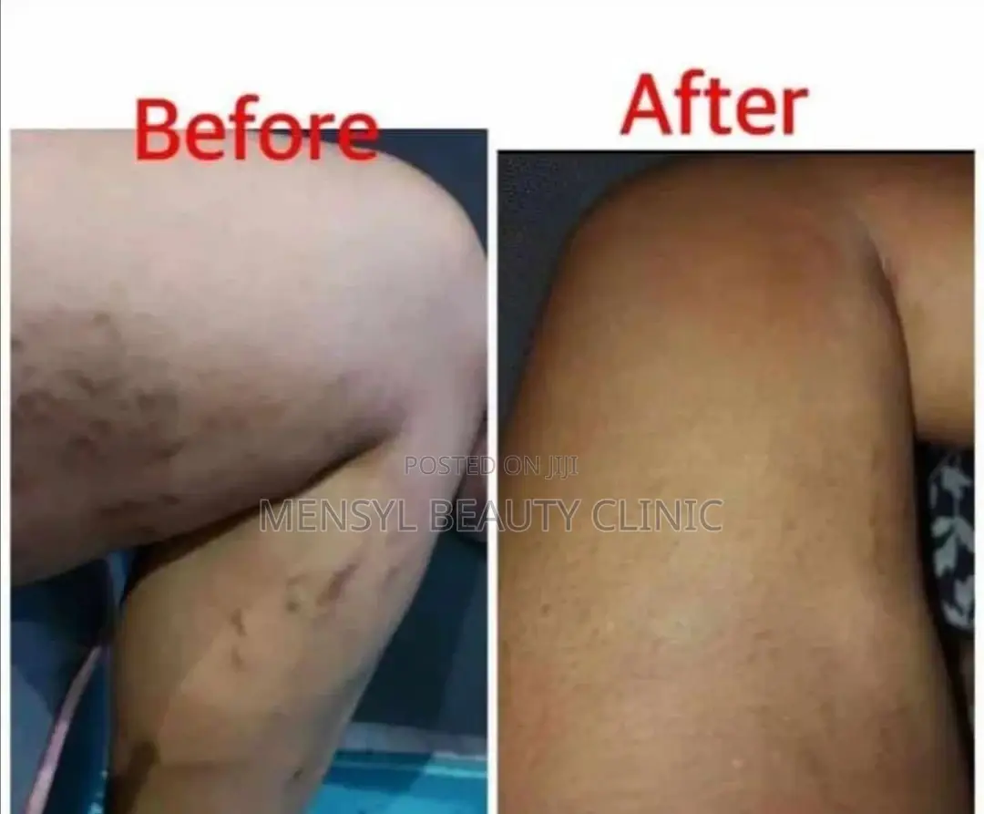 Tca Chemical Peel Solution