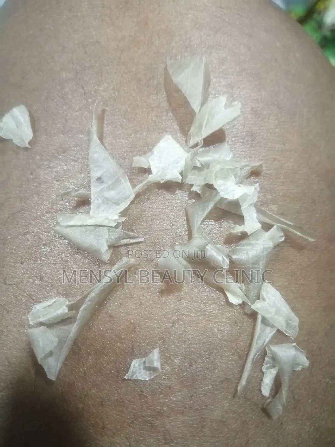Tca Chemical Peel Solution