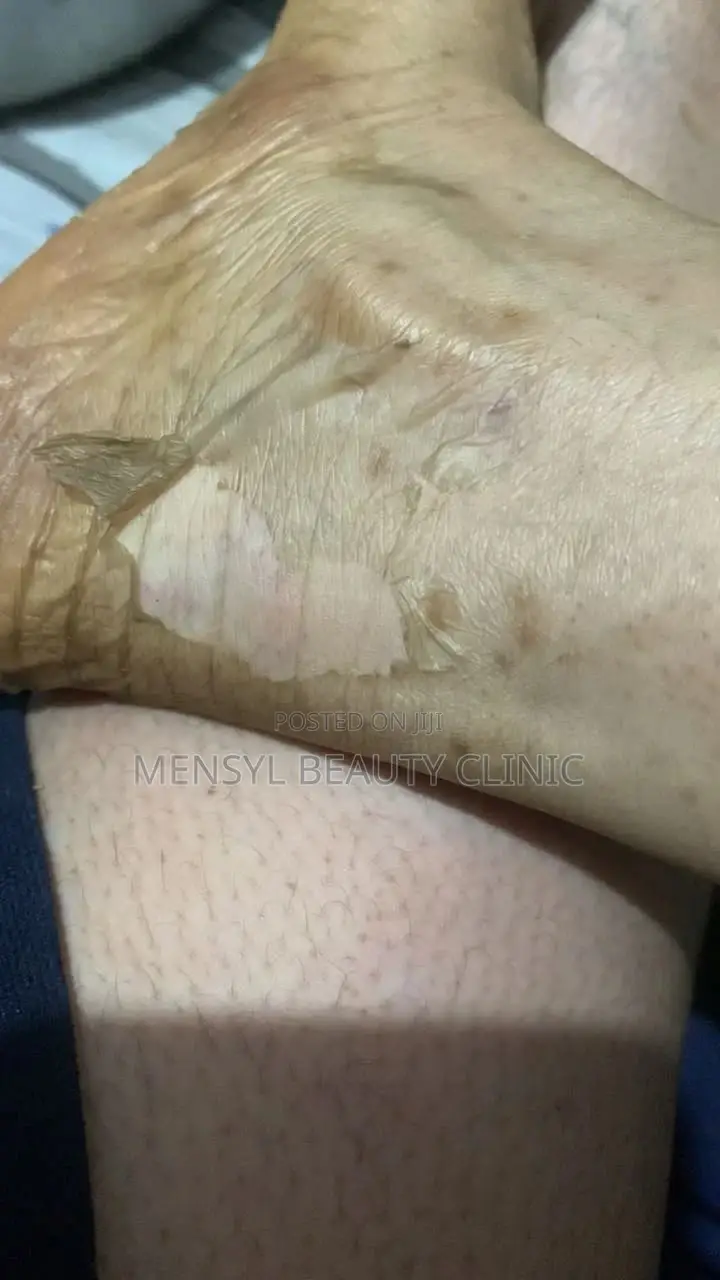 Tca Chemical Peel Solution