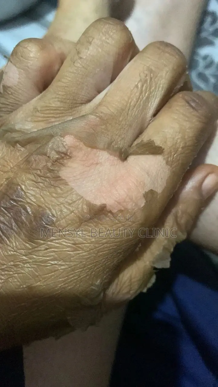 Tca Chemical Peel Solution
