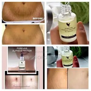 Best Stretch Marks Removal Products /Forever Living Products