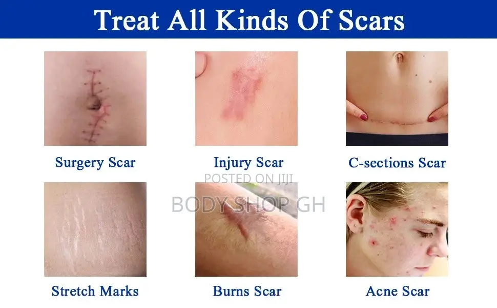 Scar Removal Cream - Advanced Scar Treatment Gel