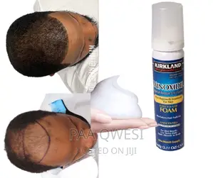 Kirkland Foam For Hair Growth