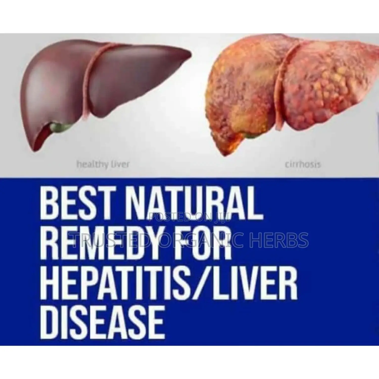 Best Natural Remedy for Hepatitis/ Liver/Kidney Disease