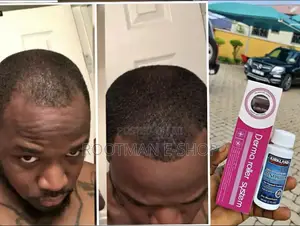 Minoxidil and Derma Roller for Faster Hair/Beard Growth