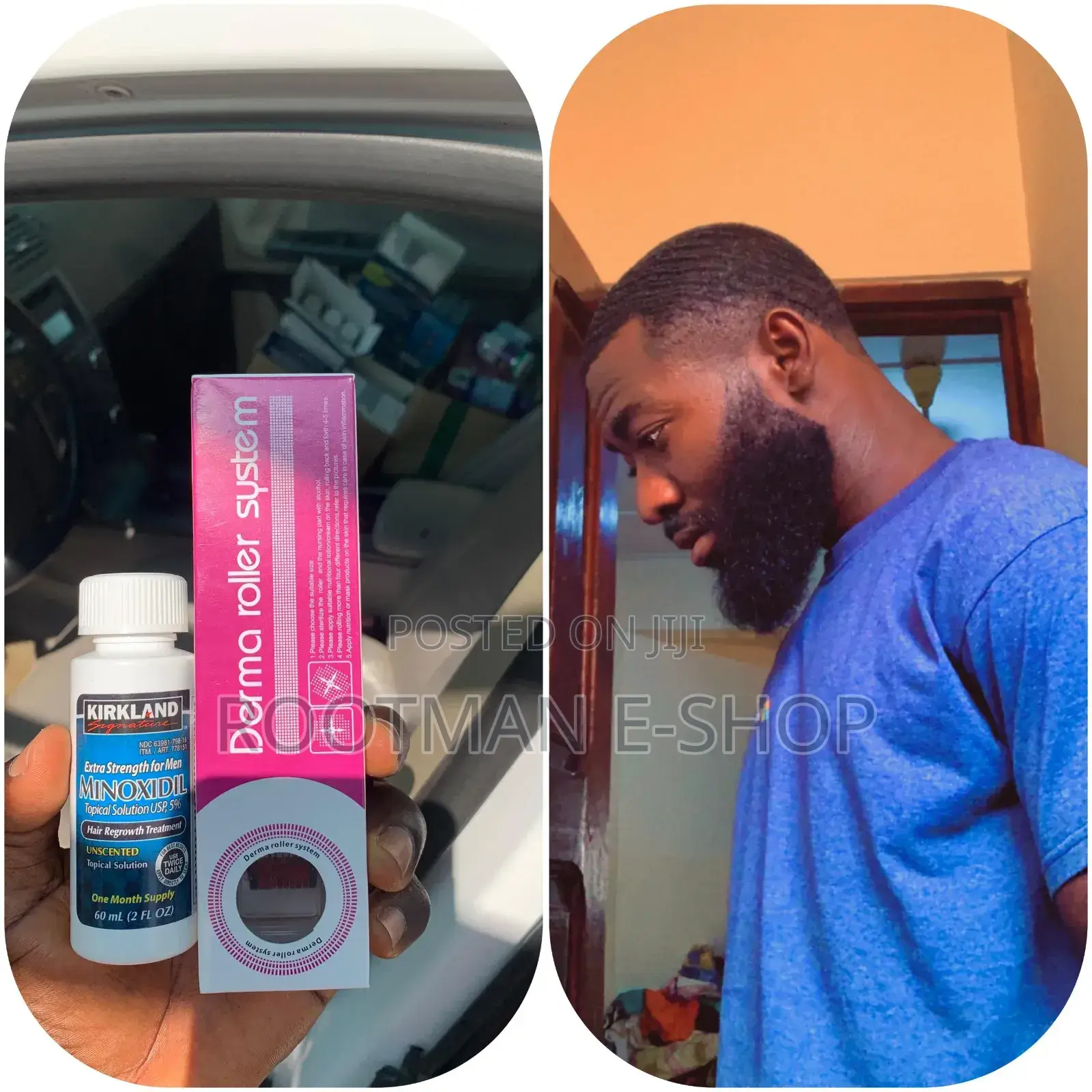 Minoxidil and Derma Roller for Faster Hair/Beard Growth