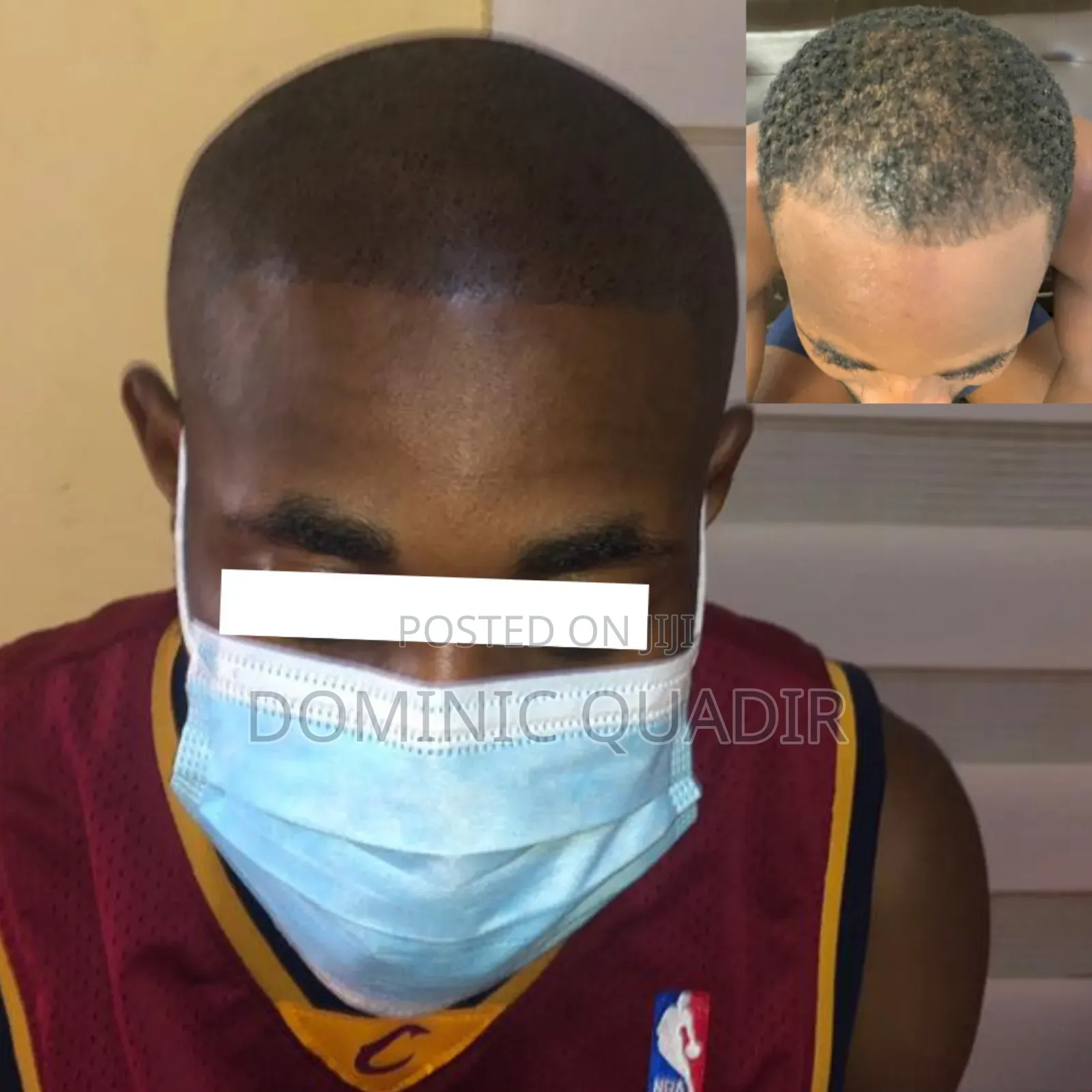 Scalp Micropigmentation
