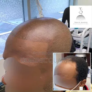 Scalp Micropigmentation