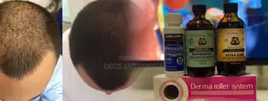 Great Product for Baldness Growth