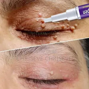 Super Active Skin Wart Remover