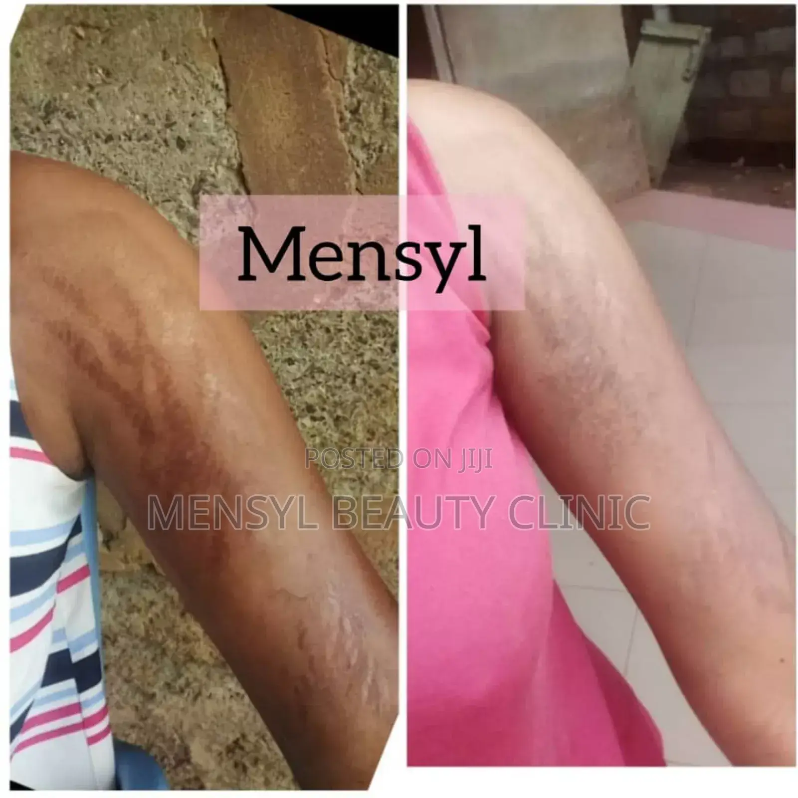 Stretch Marks Removal Therapy at Mensyl Beauty Clinic