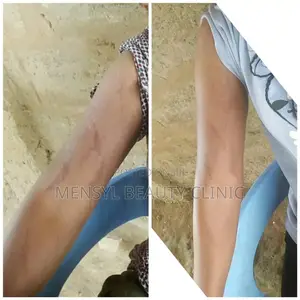 Stretch Marks Removal Therapy at Mensyl Beauty Clinic