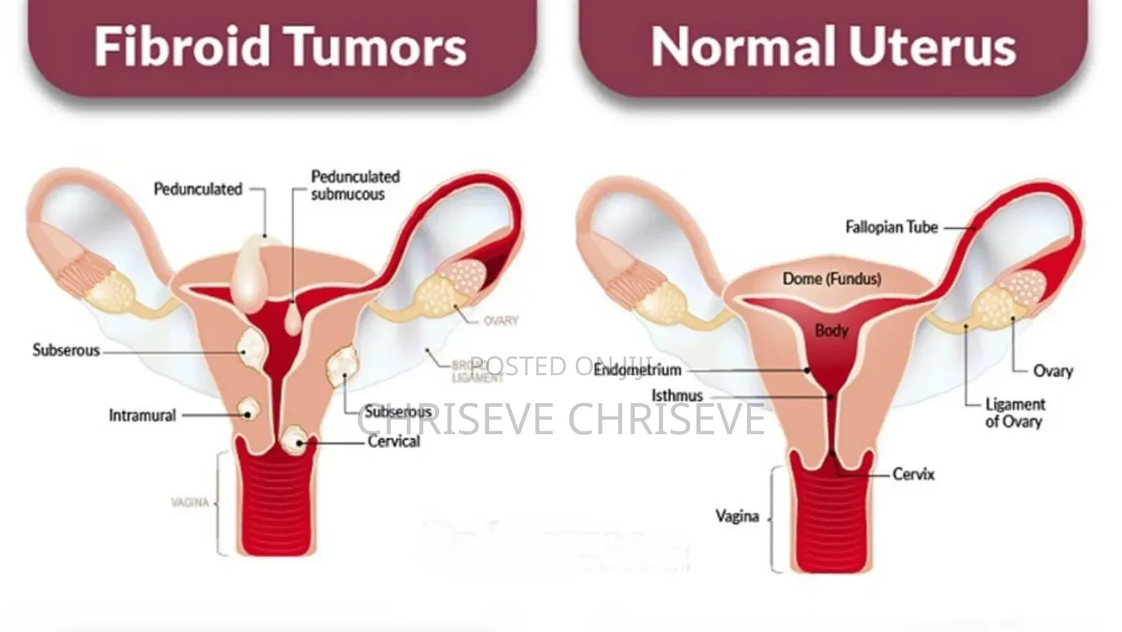 Fibroid Tea