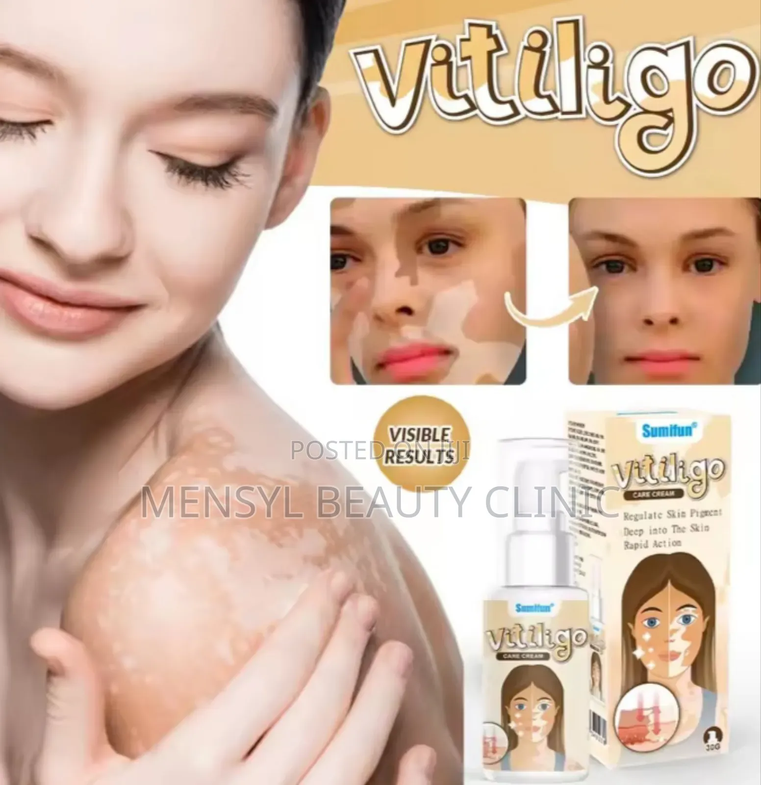 Vitiligo Spray Treatment, and White Spots on Skin