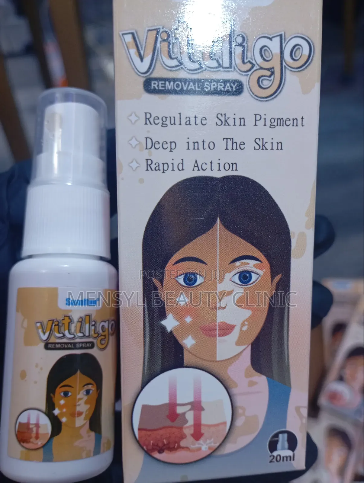 Vitiligo Spray Treatment, and White Spots on Skin