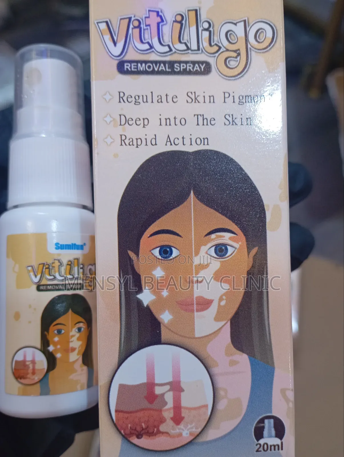 Vitiligo Spray Treatment, and White Spots on Skin