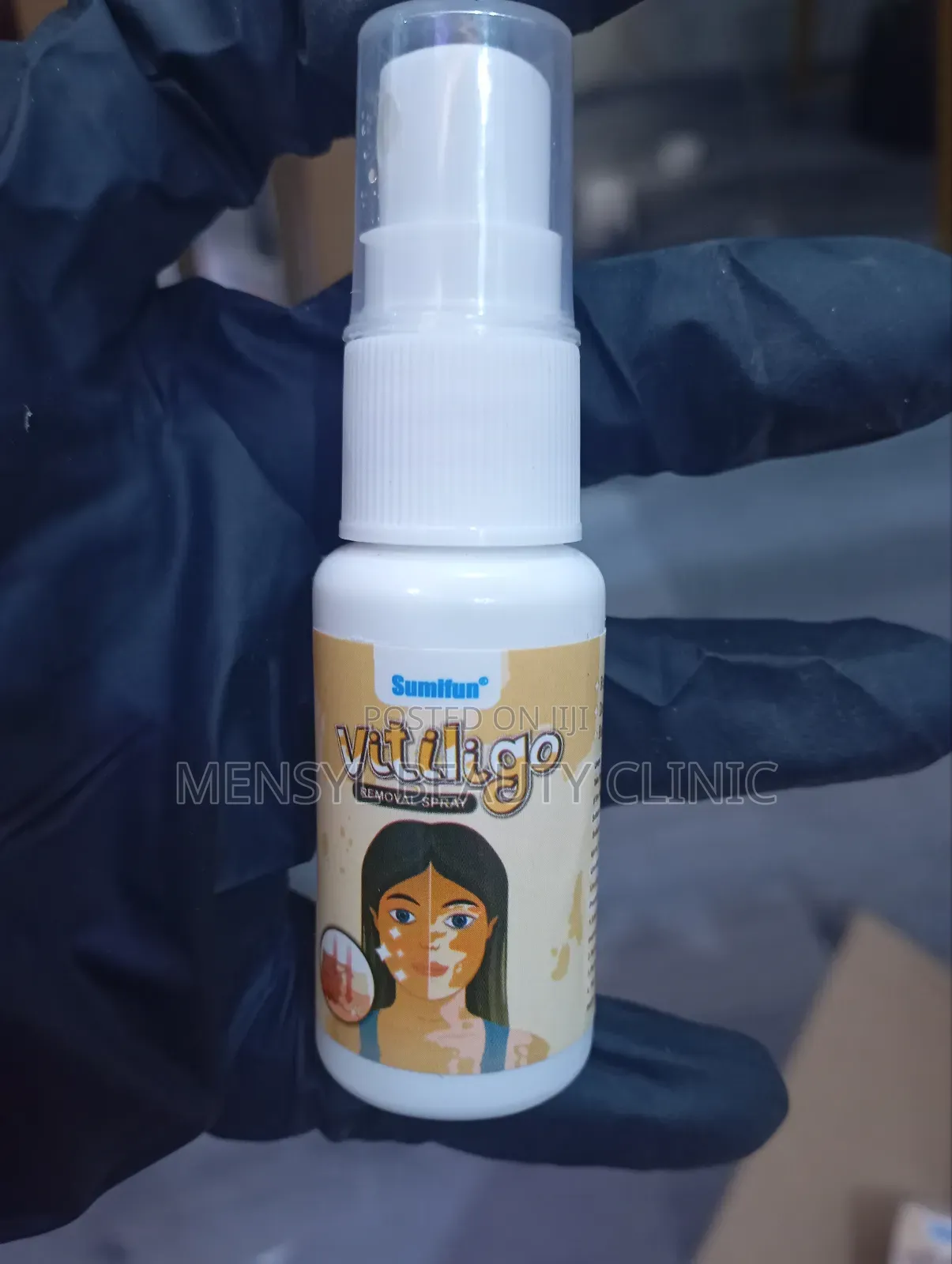 Vitiligo Spray Treatment, and White Spots on Skin