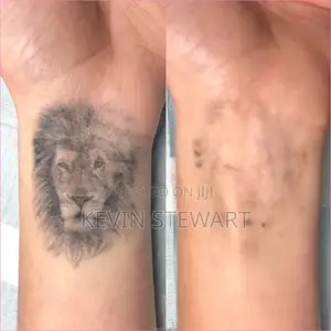 Tattoo Removal,Eye Brows Remove,Black Doll Treatment Etc