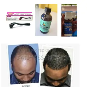 Kirkland Minoxidil,Derma Roller Peppermint Oil Combo Pack
