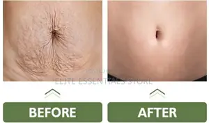 Tummy Tuck Stretch Marks Removal Skin Tightening Cream