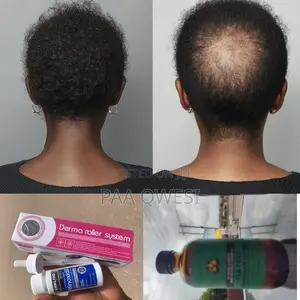3 in 1 Hair Kit: Kirkland, Castor Oil Roller