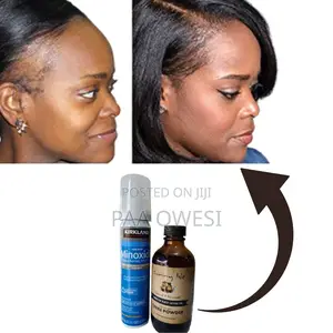 Kirkland Minoxidil Foam +Sunny Isle Chebe Powder