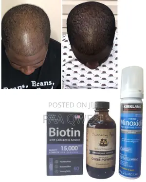 Biotin + Kirkland Foam+ Chebe Powder Oil Hair Growth Combo