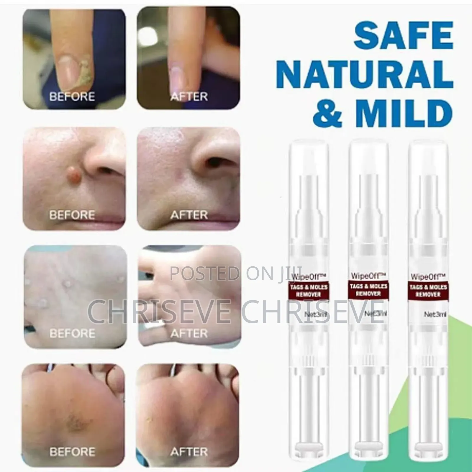 Super Active Skin Wart Remover