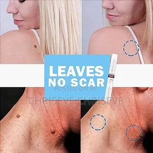 Super Active Skin Wart Remover