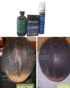 Stronger Hair Combo - Use Biotin + Kirkland Foam + Tea Tree