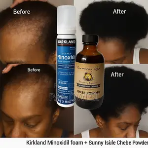Chebe Powder + Kirkland Minoxidil Foam