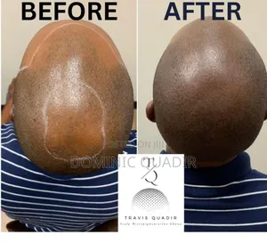Scalp Micropigmentation