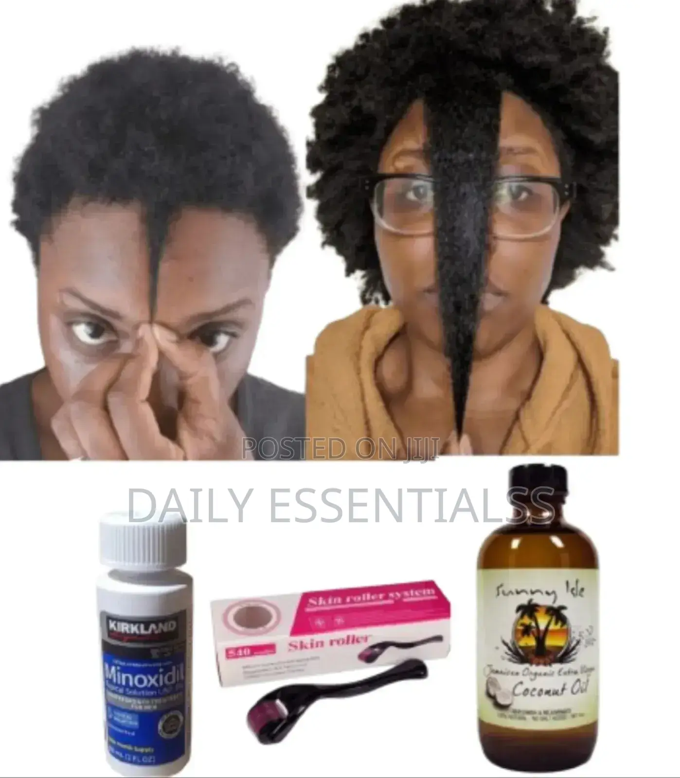 Minoxidil, Roller Sunny Isle Coconut Oil Combo