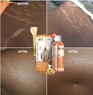 Scares Stretch Marks (Recovery Oil)